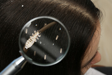 Pediculosis. Woman with lice and nits, closeup. View through magnifying glass on hair