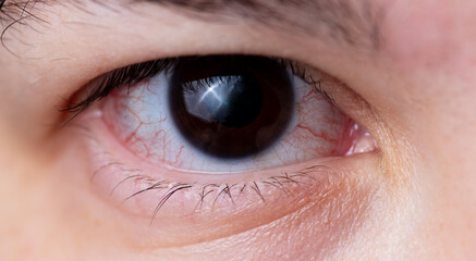 The eye with swollen capillaries is close