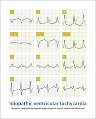 This case of ventricular tachycardia originated from the left ventricular inflow tract, which is a benign idiopathic ventricular tachycardia.