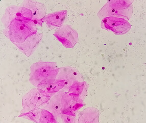 Photomicrograph of gram stain showing Bacterial Vaginosis