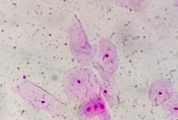 Photomicrograph of gram stain showing Bacterial Vaginosis