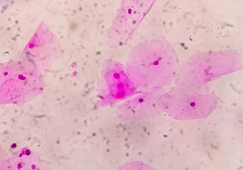 Photomicrograph of gram stain showing Bacterial Vaginosis
