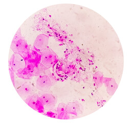 Photomicrograph of gram stain showing Bacterial Vaginosis