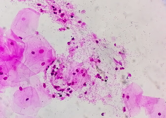 Photomicrograph of gram stain showing Bacterial Vaginosis