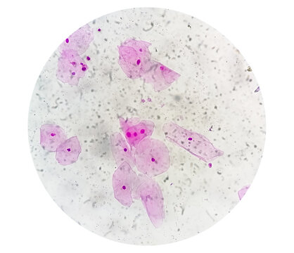 Photomicrograph of gram stain showing Bacterial Vaginosis