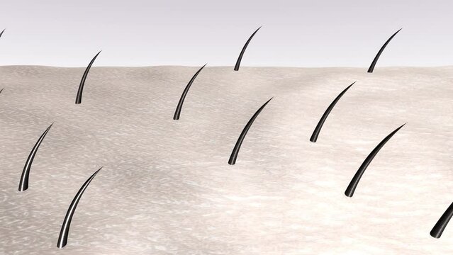 Laser hair removal. Destruction of follicles and hair loss after a few laser treatment courses. Clean smooth skin after beauty treatment by Lumenis Light Sheer laser or other equipment. 3d animation