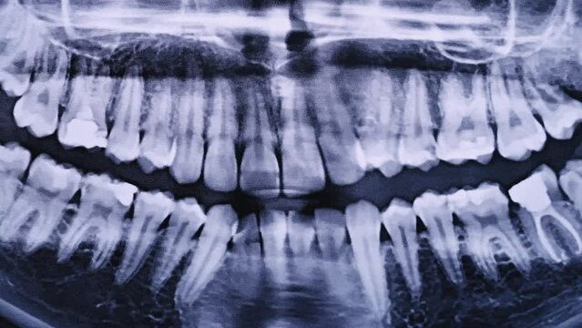 X-ray image of the jaw of all human teeth close-up. Magnetic resonance imaging of teeth. The doctor examines the x-ray of the tooth. Health care and medicine, dentistry, dentistry concept.