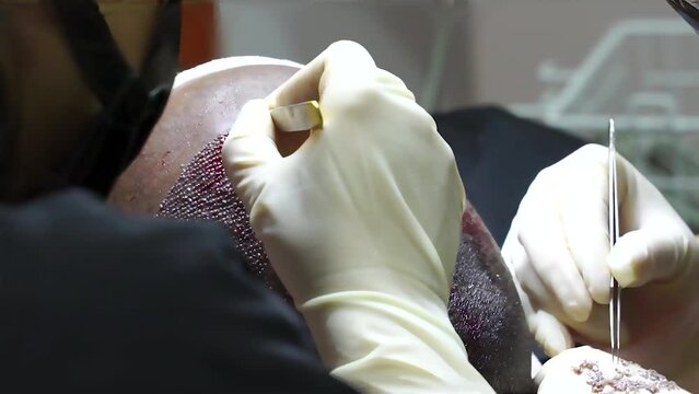 Hair Transplant Baldness Treatment. FUE Hair Transplant Patient in Clinic. Collecting hair roots and graft.