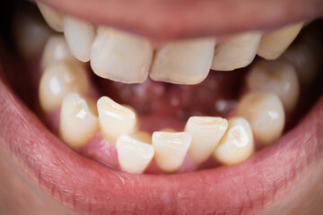 European male open mouth crooked teeth