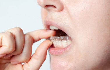 Capa after removal of braces to fix result of treatment....