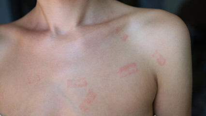 Naklejka premium Red allergic spots rash on female body closeup