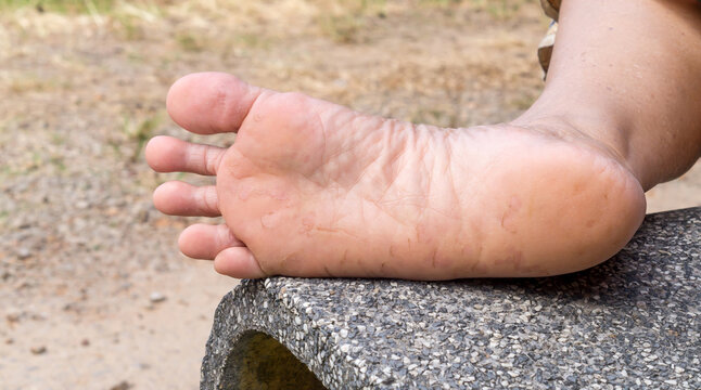 Woman suffering from foot sore caused by Athlete's foot, Patient suffering from severe foot skin disease, Close up photo of foot disease, Concept of unhealthy human foot