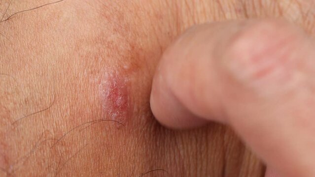 wound on skin caused by Scratch Allergic skin from mosquito