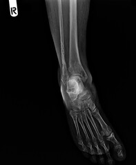 film x-ray of human's foot ( side view ) ( lateral )