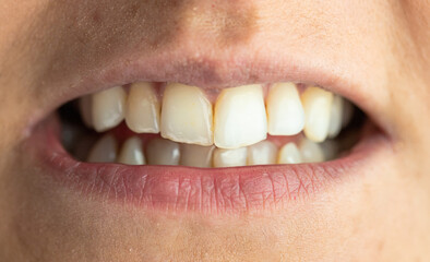 Female teeth in close-up, oral health care