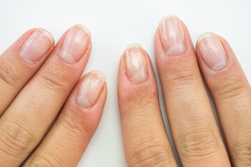 Nail health, female hands close-up,