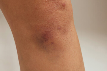 Hematoma and Large Bruise, blood under skin Congestion.