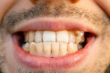 anterior crossbite smile. Curved male teeth, before installing braces. - 561480485