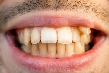 Close up of man's face with crooked teeth before install braces. Teeth need ortodontic treatment.