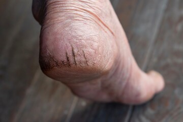 Painful cracked heel of Asian woman. Dry foot skin.