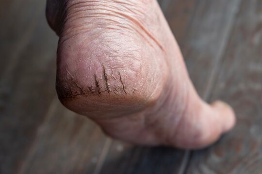 Black cracked feet best sale