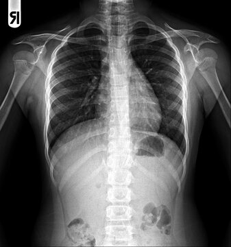 Film chest x-ray PA upright show normal  chest.