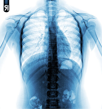 Film chest x-ray PA upright show normal  chest.