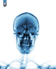 Film x- ray skull AP normal 