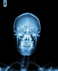 Fototapeta na wymiar Film x- ray skull AP normal 