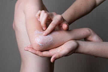 allergy on the elbows in a child, rash and redness, atopic dermatitis, women's hands apply ointment...