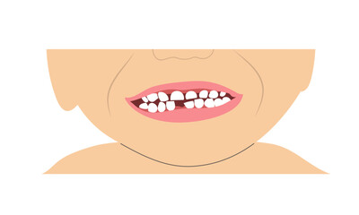 Little boy smile missing tooth due to change of milk teeth. Simple minimalistic illustration of baby mouth with incomplete set of teeth.