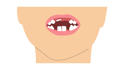 A boy smile missing tooth due to change of milk teeth. Simple minimalistic illustration of baby mouth with incomplete set of teeth.