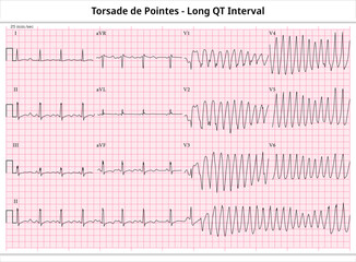 ECG Torsade de Pointes - Long QT Interval - Ventricular Tachycardia - 12 Leads ECG Paper - Vector Medical Illustration