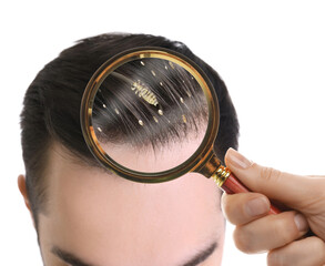 Pediculosis. Man with lice and nits on white background, closeup. View through magnifying glass on...