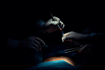 Closeup surgical team performing surgery to patient in sterile operating room. In a surgery room...