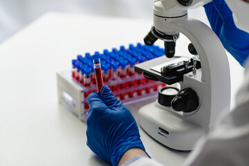 Doctor's hands in medical gloves holding a test tube with red blood for the sagittal microscopic test in the hematology laboratory at the hospital
