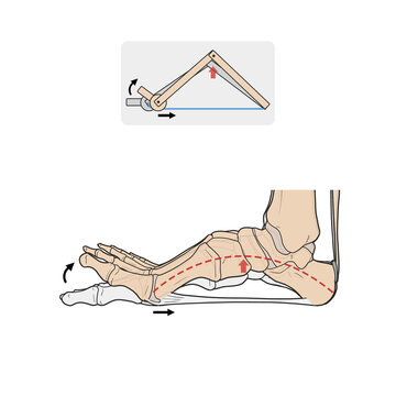족저근막 windlass 해부학 메디컬일러스트