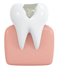 3D Rendering tooth with cavity and titanium filled icon cartoon style isolated on white. 3D Render illustration.