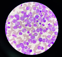 Blood smear leukaemia white blood cells blast.