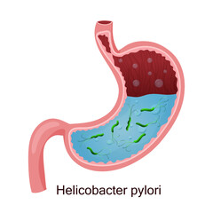 Helicobacter pylori in stomach. Vector illustration, cartoon style, white background