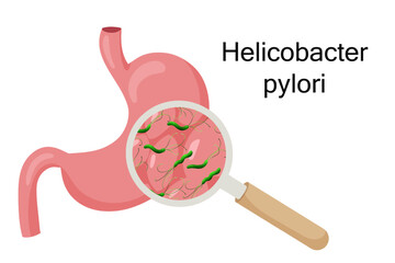 Gastritis with helicobacter pylori under magnifying glass. Vector illustration, cartoon style