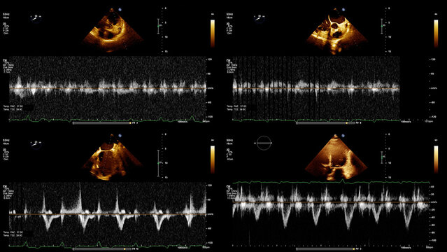 Image of the heart during transesophageal ultrasound