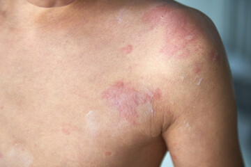 food allergy. a boy with red spots. The child has itching, with an allergic rash..