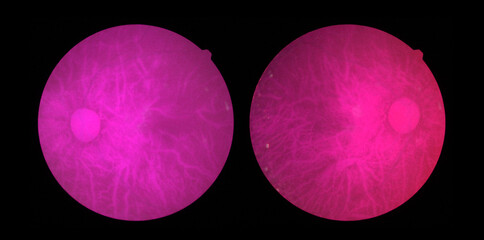 Photo Madical Retina Abnormal isolated on black background.Purple Retina of diabetes , diabates...