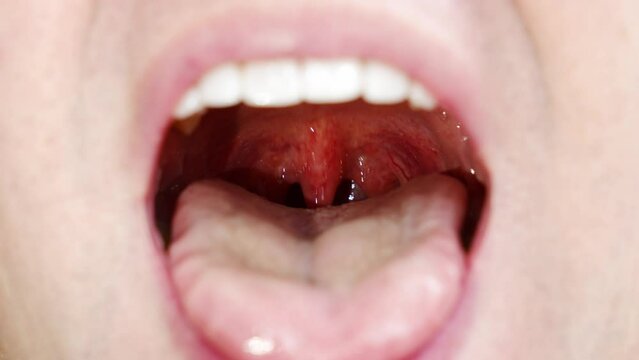 a man's mouth close-up. focus on the palatine uvula and mucous membrane of the throat. the concept of examination of the oral cavity, sore throat.