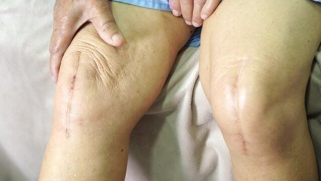 Asian senior or elderly old lady woman patient show her scars surgical total knee joint replacement Suture wound surgery arthroplasty on bed in nursing hospital ward, healthy strong medical concept.