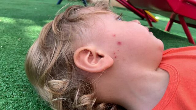 Baby Infant Mosquito Bites On Face After Scratching. Child Bruises Due To Scratch Itching