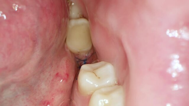 Close-up oral cavity of a patient who has just had a gum augmentation for implant placement, protecting the patient's gums with black threads to increase bone growth.Process of installing an implant
