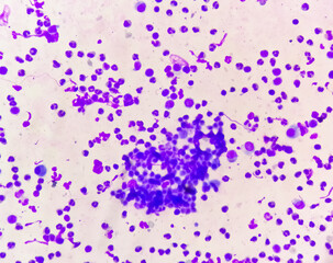 Fototapeta premium Synovial Fluid Cytology: Plenty WBC, microscopic examination of synovial fluid, to diagnose arthritis, particularly for septic or crystal-induced arthritis.