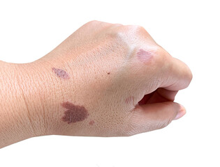 Fototapeta premium wounds from cooking oil splashed on hands, on white background, isolated